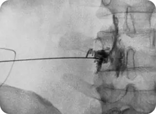 신경성형술(PEN) 사진2