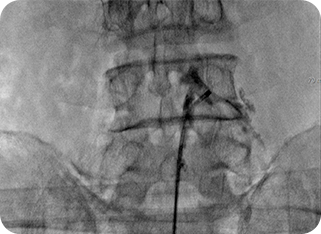 풍선확장술 사진1