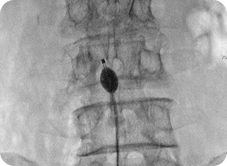 풍선확장술 사진2