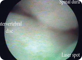 내시경 신경성형술  사진2