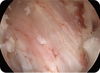 내시경 감압술 사진2