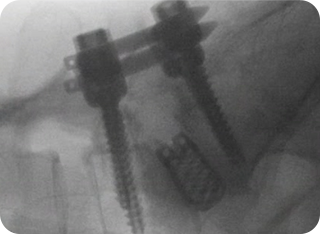 내시경 유합술 사진2
