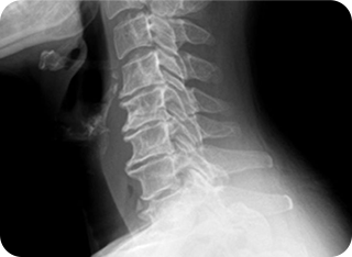 보행 장애 사진1