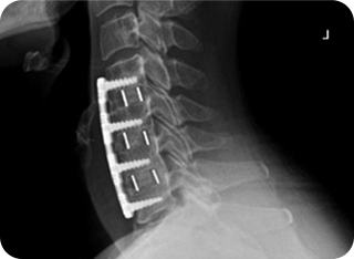 보행 장애 사진2