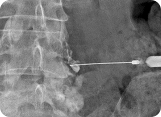 주사치료 사진2