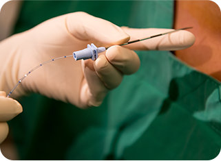 신경성형술(PEN) 사진1