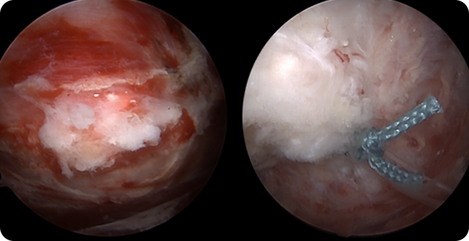 인대 봉합술&재건술