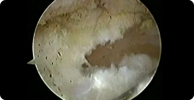 최소절개 관절내시경