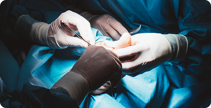 무지외반증 수술