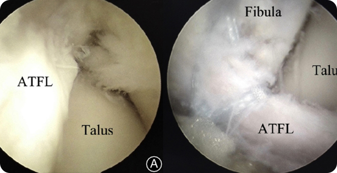 인대 봉합술&재건술