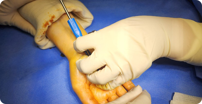 수근관 유리술 사진