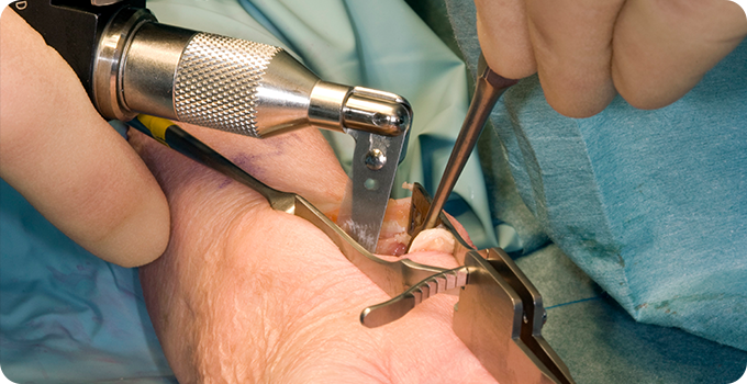 건초막 절개술 사진