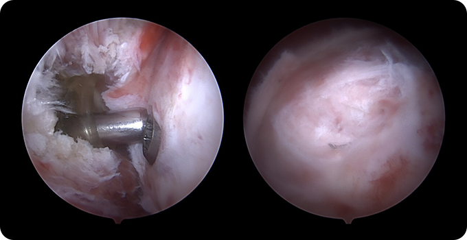 TFCC 복구술 사진