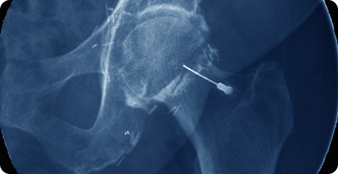 재생주사치료 치료 사진