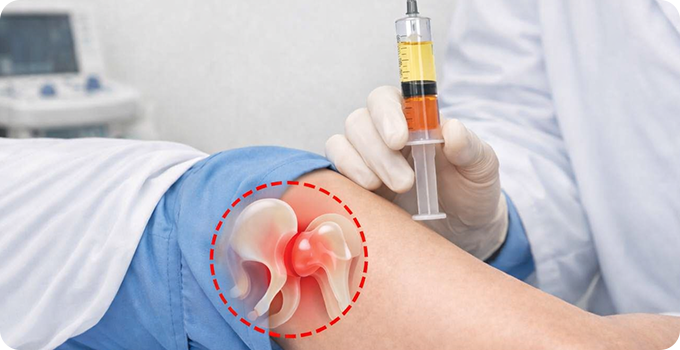 자가 줄기세포 이식술 치료 사진