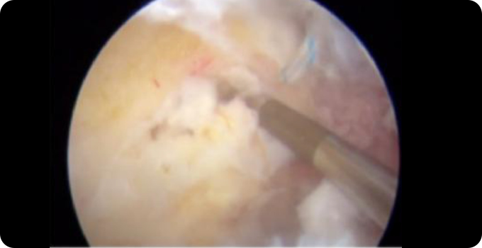 최소절대 관절내시경 치료 사진