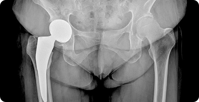 인공관절 수술 치료 사진
