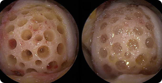 최소절대 관절내시경 치료 사진