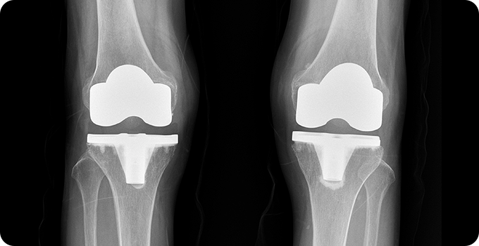 인공관절 수술 치료 사진