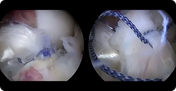 십자인대 재건술 치료 사진