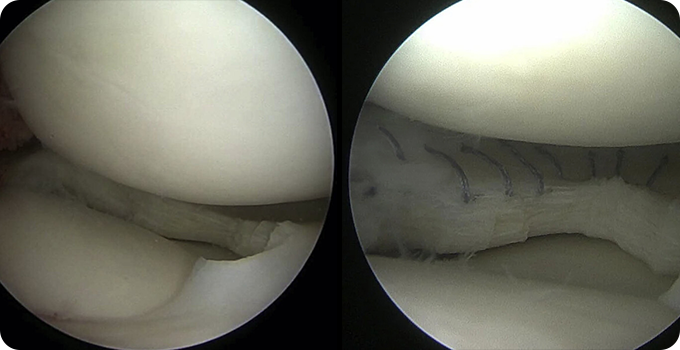 연골 봉합술&절제술 치료 사진
