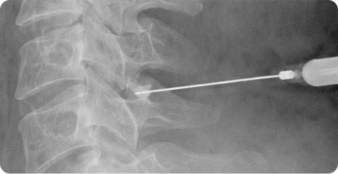 신경차단술 사진