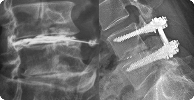 척추 감압술&고정술 사진