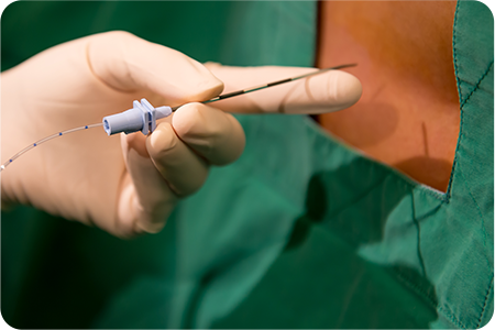 특수 내시경을 이용한 치료하는 사진