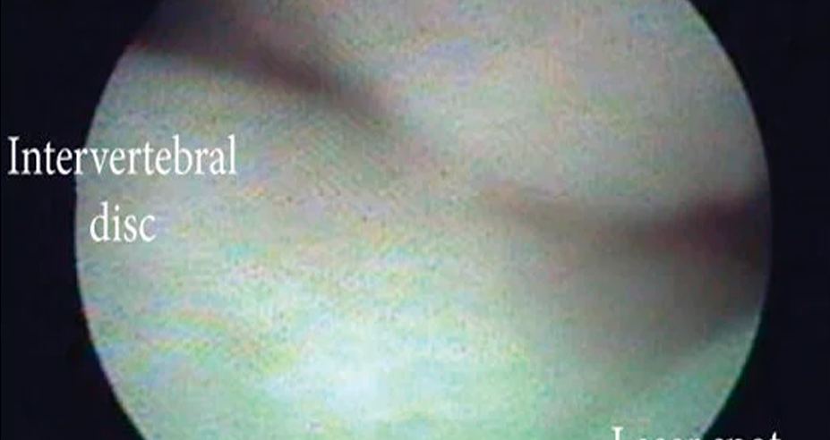 내시경 신경성형술 이미지