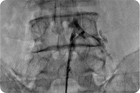 카테터 삽입 및 신경 유착 제거하는 사진