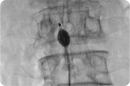 치료 약물 주입 및 마무리 하는 사진