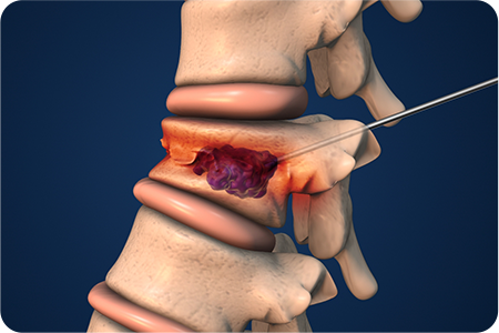 바늘 삽입 및 골시멘트 주입하는 사진