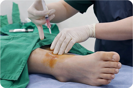 치료 약물 주입하는 사진