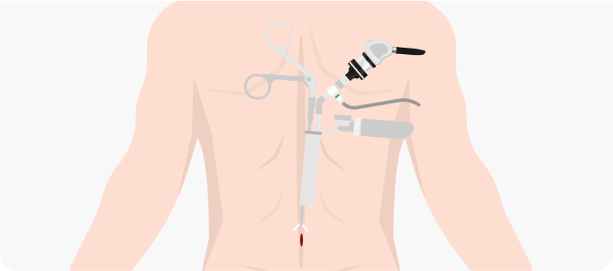 단방향 척추 내시경 관련 이미지