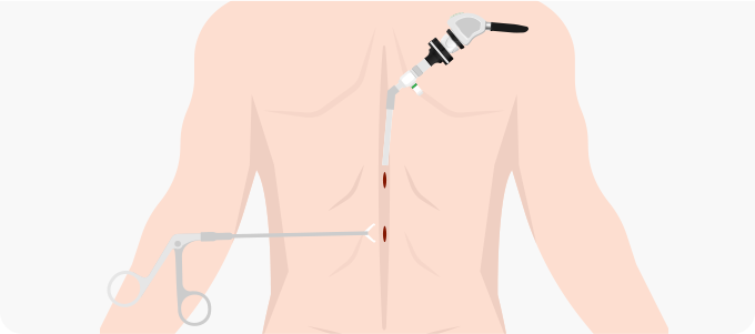 양방향 척추 내시경 관련 이미지