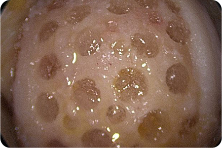 줄기세포 농축 및 이식하는 사진