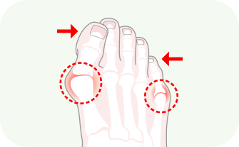 발 20도 이하의 변형 이미지