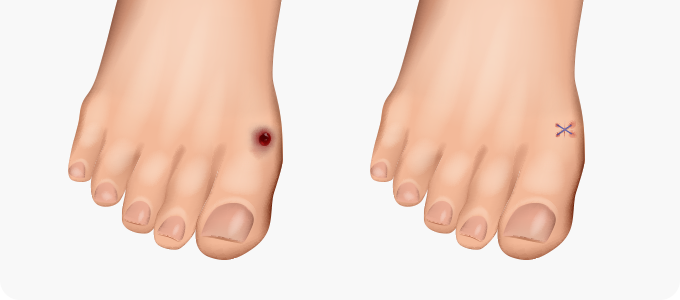 최소침습 무지외반증 수술 이미지