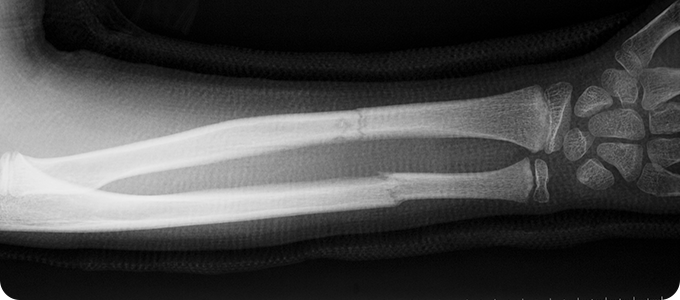 상지골절 이미지