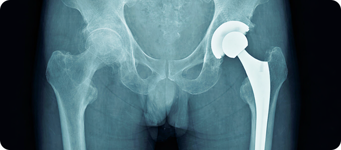 인공관절 치환술 사진