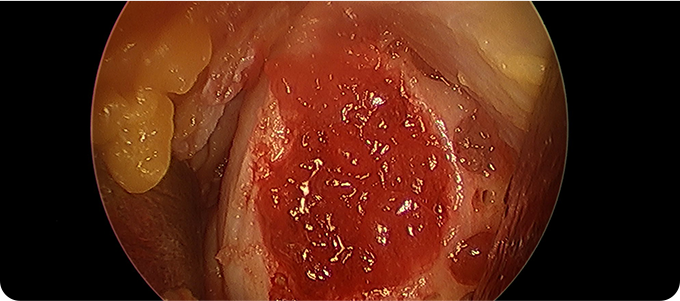 카티스템 관련 이미지