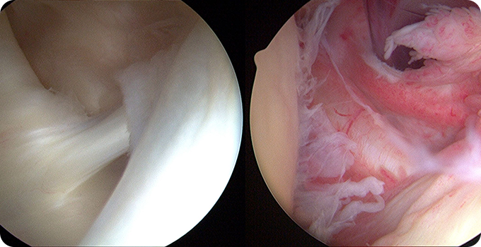 최소절대 관절내시경 치료 사진