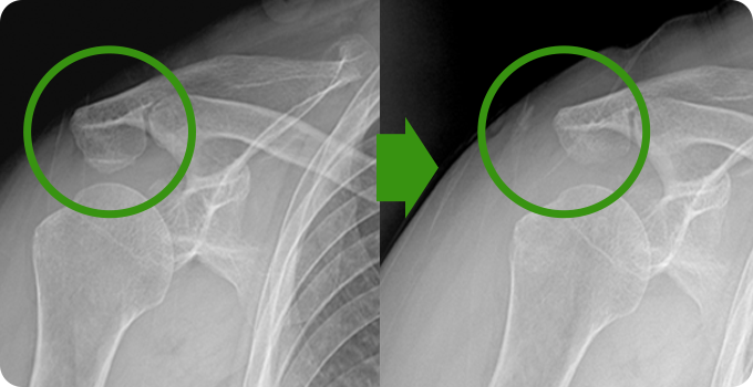 견봉성형술&감압술 치료 사진