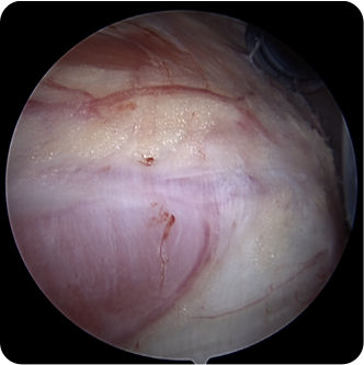 정상인 모습의 회전근개