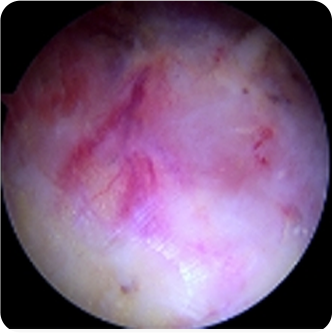 건염인 모습의 회전근개