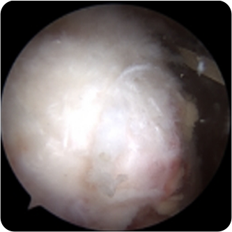 부분파열(저등급)인 모습의 회전근개