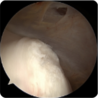부분파열(중간등급)인 모습의 회전근개