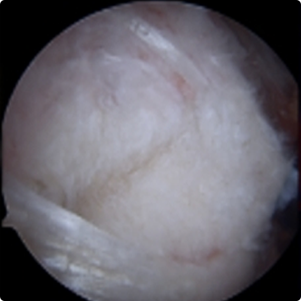 부분파열(고등급)인 모습의 회전근개
