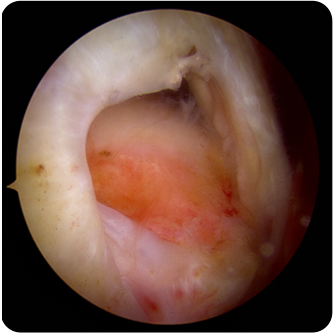 전층파열(중파열)인 모습의 회전근개