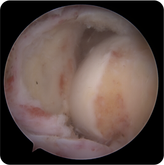 전층파열(대/거대)인 모습의 회전근개